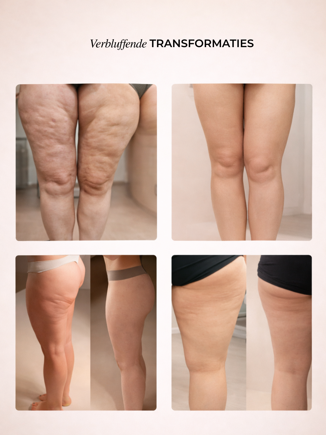 Norivae Contoura™ | Cellulite zichtbaar verminderen vanuit huis