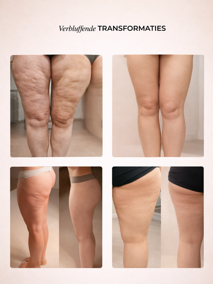 Norivae Contoura™ | Cellulite zichtbaar verminderen vanuit huis